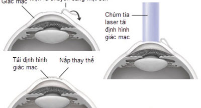lasik có gây đau không