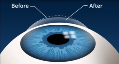 cham soc mat sau phau thuat lasik