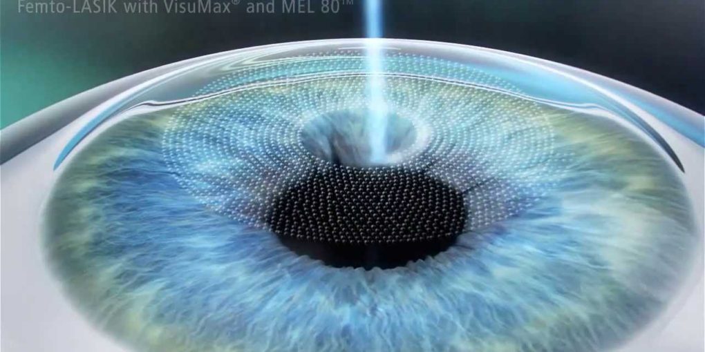 Điều trị cận thị bằng phuong phap Femto Lasik