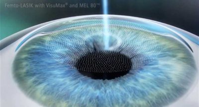 Điều trị cận thị bằng phuong phap Femto Lasik