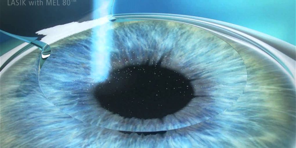 phương pháp lasik -phau thuat lasik