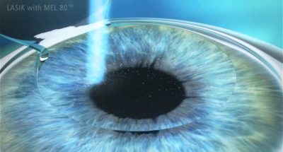 phương pháp lasik -phau thuat lasik