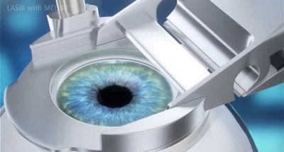 Phương pháp Lasik có an toàn