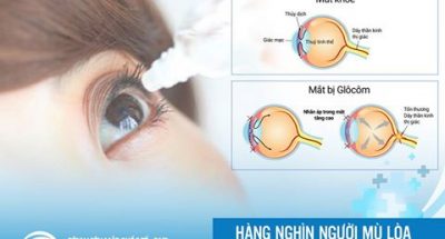 Corticoid trong thuốc chữa bệnh mắt có thể gây mù lòa